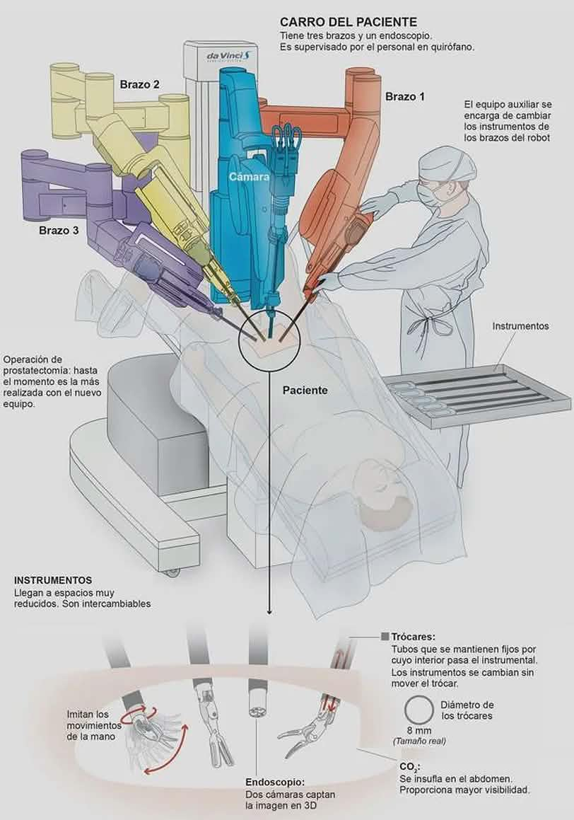 Imagen del uso del robot Da Vinci con sus cuatro brazos.